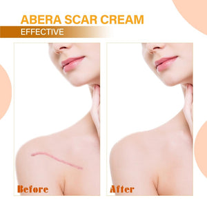 Abera Scar Removal Cream✨